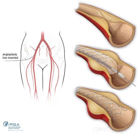 Lower Limb Angioplasty and Stenting | IRSA