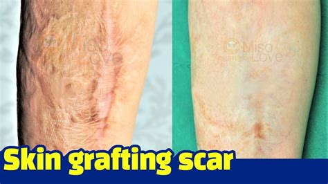 [Scar clinic in korea]Skin grafting scar treatment - YouTube