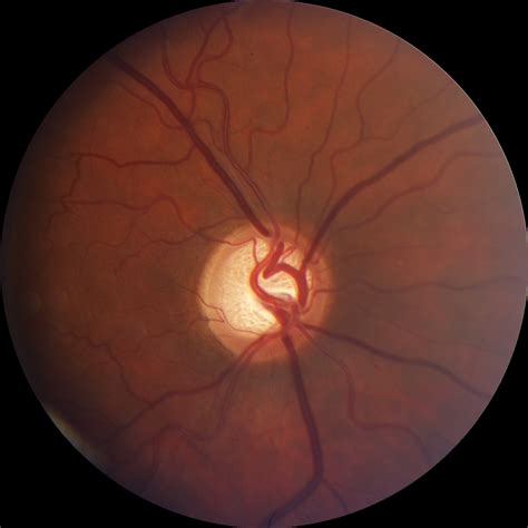 Moran CORE | Glaucomatous Cupping