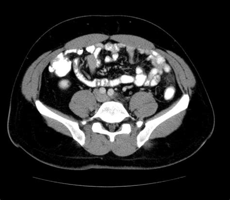 Epiploic appendagitis - wikidoc