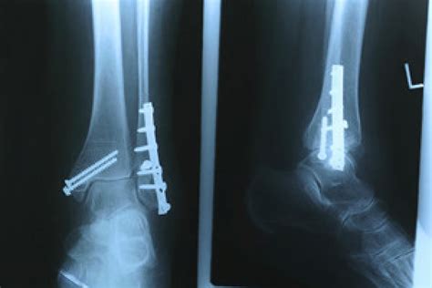 ORIF for an Ankle Fracture