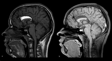 Pericallosal lipoma associated with corpus callosum dysgenesis | Eurorad