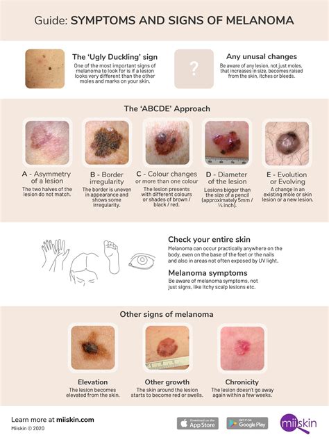 What Are The Signs And Symptoms Of Melanoma Skin Cancer / Know 5 Sign ...