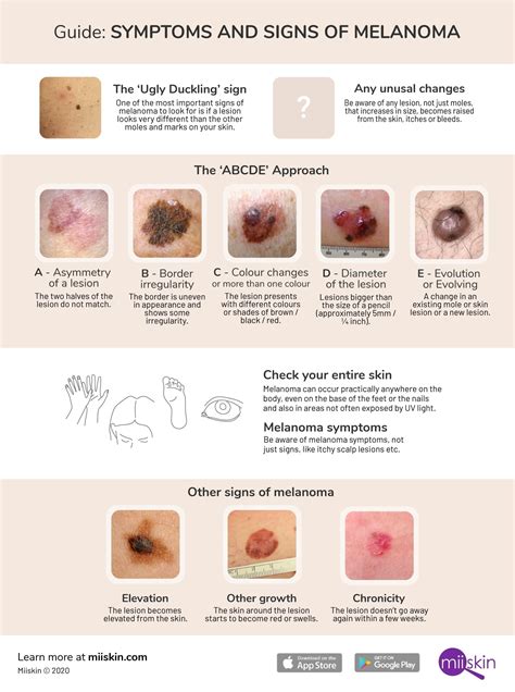 Melanoma Symptoms and Signs: Extensive Guide