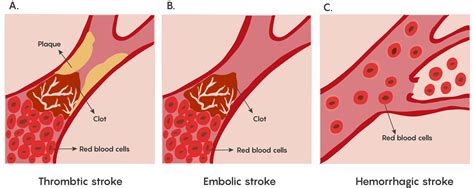 2.2 Stroke and Loss of Blood Flow as an Acute Injury to the Brain ...