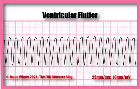 Ventricular Flutter