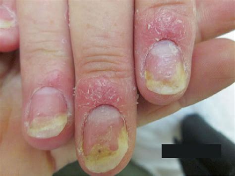 Nail psoriasis causes, symptoms, diagnosis, treatment & prognosis