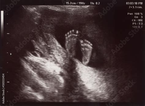 "Ultrasound of In Uterus Baby at 22 weeks. Healthy baby in belly ...