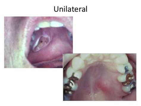 Necrotizing sialometaplasia