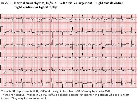 stepwise interpretation of ECG ID279 RVH