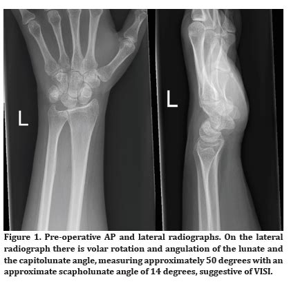 The ArmDoc - Lunotriquetral Ligament Injury