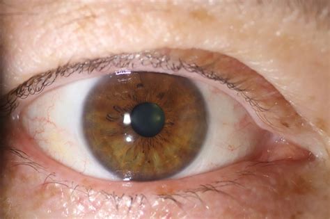 Pterygium - Dr Tom Cunneen - Eye Surgery Perth