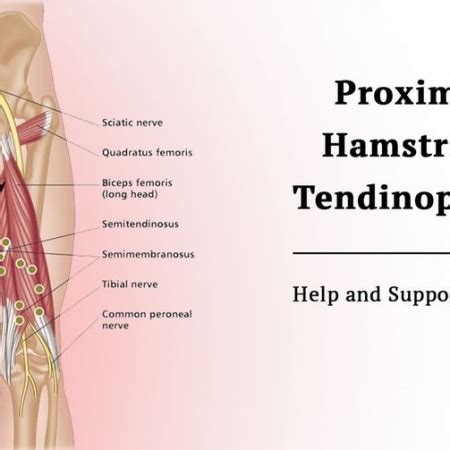 Help With Sitting - Proximal Hamstring Tendinopathy