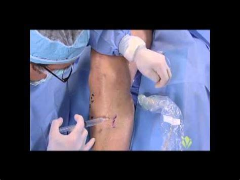 Great Saphenous Vein & Microphlebectomy - Radio Frequency Ablation - YouTube