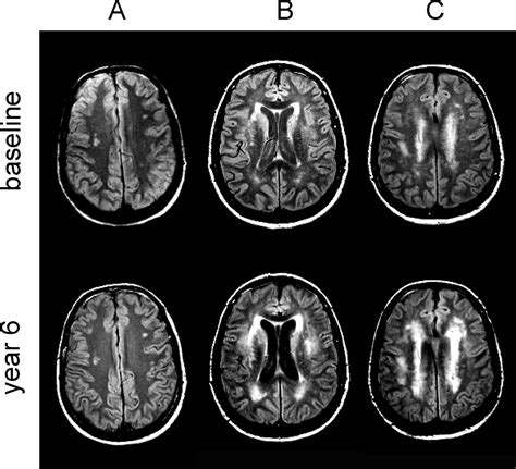 Progression of Leukoaraiosis and Cognition | Stroke