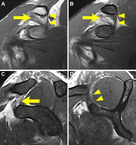 Grade 2 acromioclavicular injury: partial injury of coracoclavicular... | Download Scientific ...