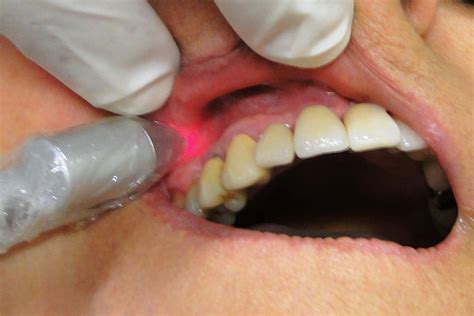 Low Level Laser Therapy In Dentistry | Alux Dental