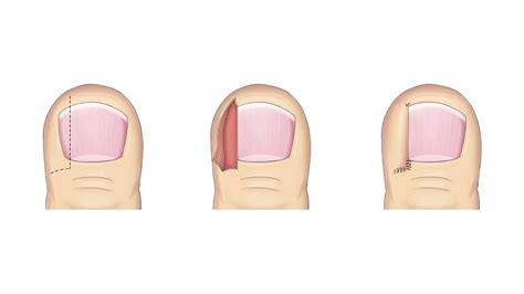 Ingrown Toenail Management – The Podiatric Method | Lower Limb Specialist Centre