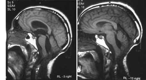 Severe Hydrocephalus Mri