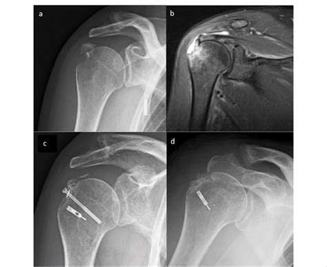 Greater Tubercle Of Humerus Fracture