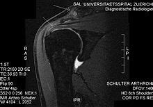 Shoulder impingement syndrome - Wikipedia