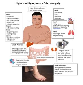 Acromegaly - WAPO