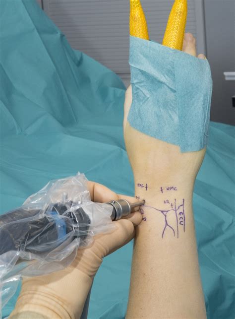 Diagnostic Wrist Arthroscopy (using Acumed ARC Tower ) Surgical Technique - OrthOracle