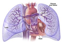 Pulmonary Endarterectomy Surgery India, India Pulmonary Endarterectomy