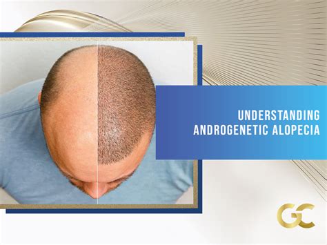 Understanding Androgenic Alopecia - Gold City Best Hair Transplant Turkey