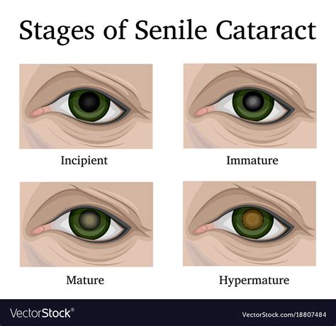 Stages of senile cataracts Royalty Free Vector Image