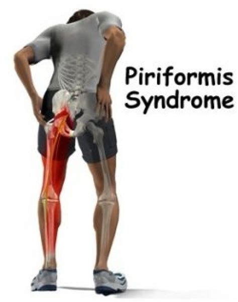 Piriformis syndrome : How to manage the pain for the time being