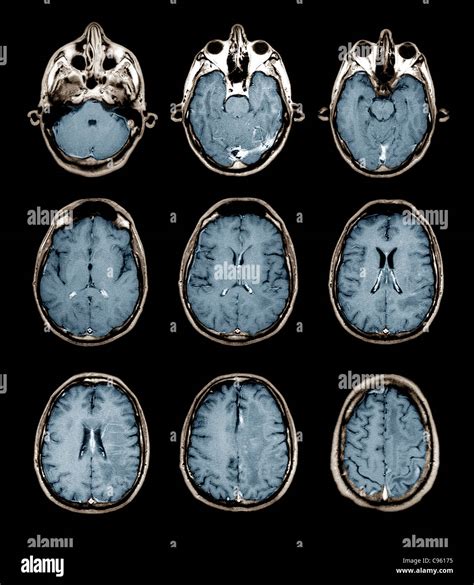 Normal MRI Brain Scan