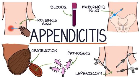 5 Appendicitis Symptoms and Warning Signs - Signs of Appendicitis ...