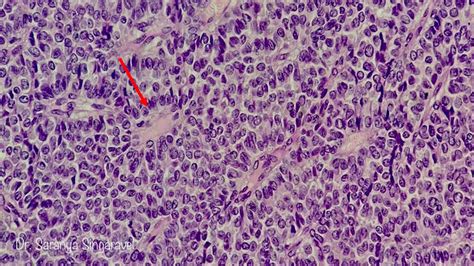 GRANULOSA CELL TUMOR- OVARY | Pathology Made Simple