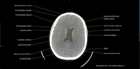 Approach to CT head | LearningNeurology.com