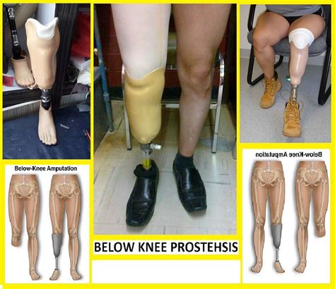 Physical Therapy Guide to Below-Knee Amputation (Transtibial Amputation)