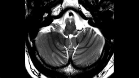 Cerebellar Lesions - The Neurology Hub