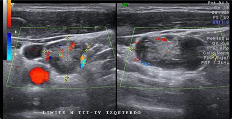 Lymph Node Anatomy Ultrasound