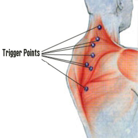 Trigger point injections | Utah Spine Specialists