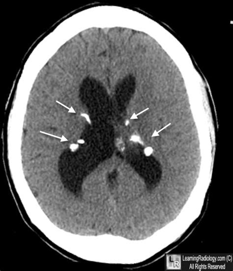 Learning Radiology - Intracranial, Tuberous Sclerosis, brain