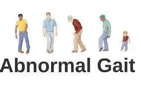 Abnormal Gait - Types, Symptoms, Treatment, Exercise - Mobile