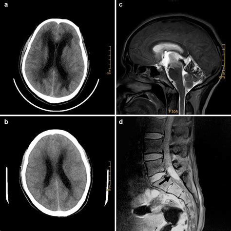 a, b CT scans of patient II:8, showing the hydrocephalus and... | Download Scientific Diagram