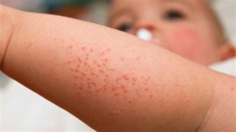 The Most Effective Treatments For Heat Rash 2020 - Health Cautions