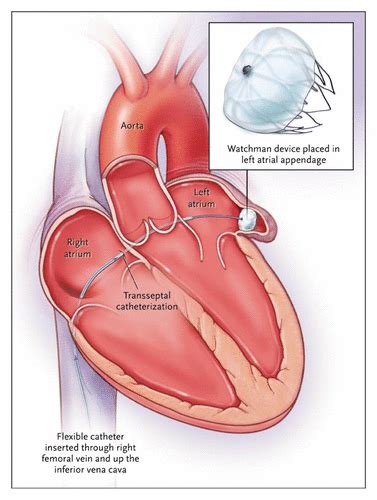 Left Atrial Appendage Occlusion — Closure or Just the Beginning? | NEJM