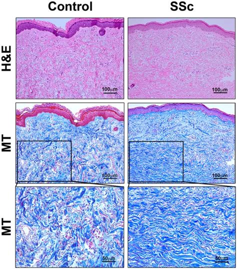 Histopathology of skin lesions in SSc patients. Skin sections from ...