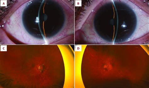 (A, B) Slit lamp images showing a moderately deep anterior chamber... | Download Scientific Diagram