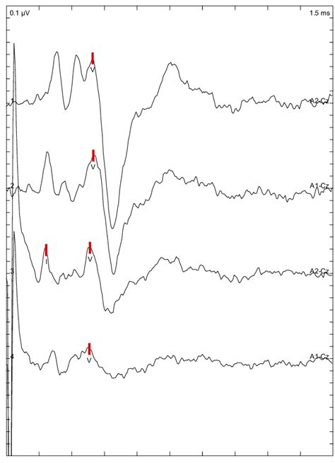 Bone conduction auditory brainstem response waveforms from the left ear... | Download Scientific ...