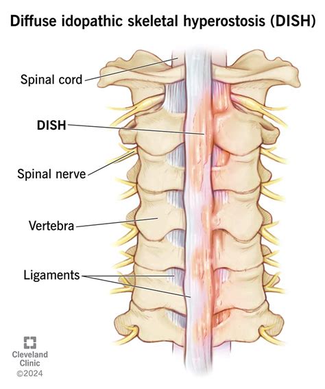 Diffuse Idiopathic Skeletal Hyperostosis (DISH Disease)