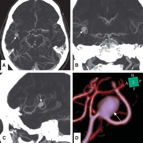 Posts tagged "middle-cerebral-artery" - Neurosurgery Blog