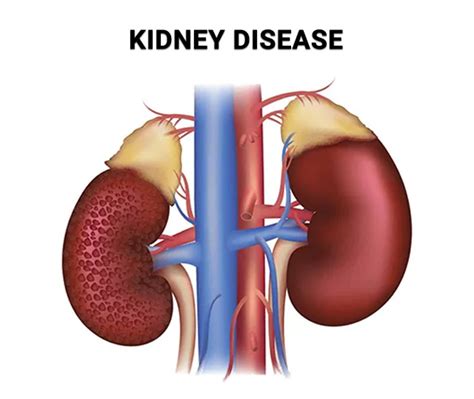 How Long Can You Stay in Stage 3 Kidney Disease? - Century Medical ...